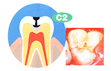 C2　象牙質まで進行した虫歯