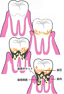 歯周病とは