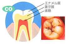 CO　歯の表面の白斑