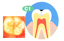 C1　エナメル質までの虫歯