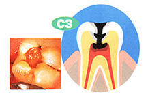 C3　神経（歯髄）に達した虫歯