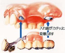 磁石方式の入れ歯って何？