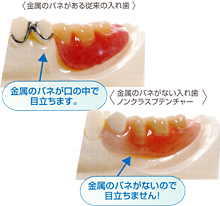 金属のバネがない入れ歯　ノンクラスプデンチャー